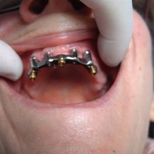 Laboratoire prothese dentaire : Comment cela fonctionne ?